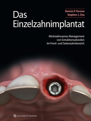 cover image of Das Einzelzahnimplantat